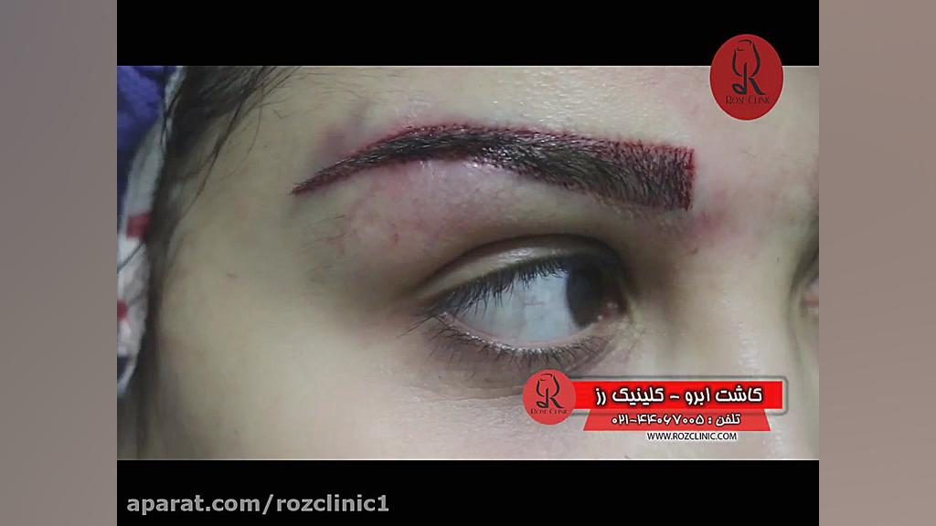کاشت ابرو | فیلم کاشت ابرو | کلینیک پوست و مو رز | شماره36 لمینت