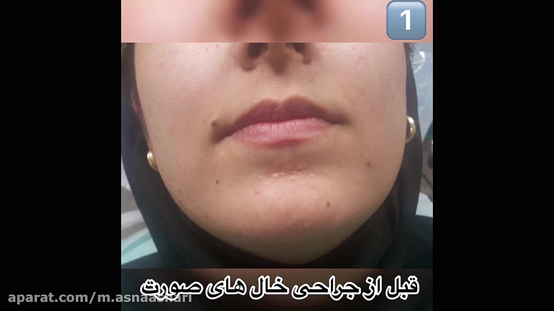 برداشتن خال های روی صورت با لیزر دیود پزشکی دریایی