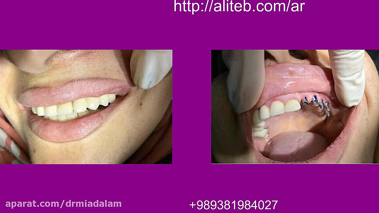 کاشت دندان ، عصب کشی ، ارتودنسی ، لمینت دندان و... دکتر میعاد علم - کلینیک دندان پزشکی ، کاشت دندان ، عصب