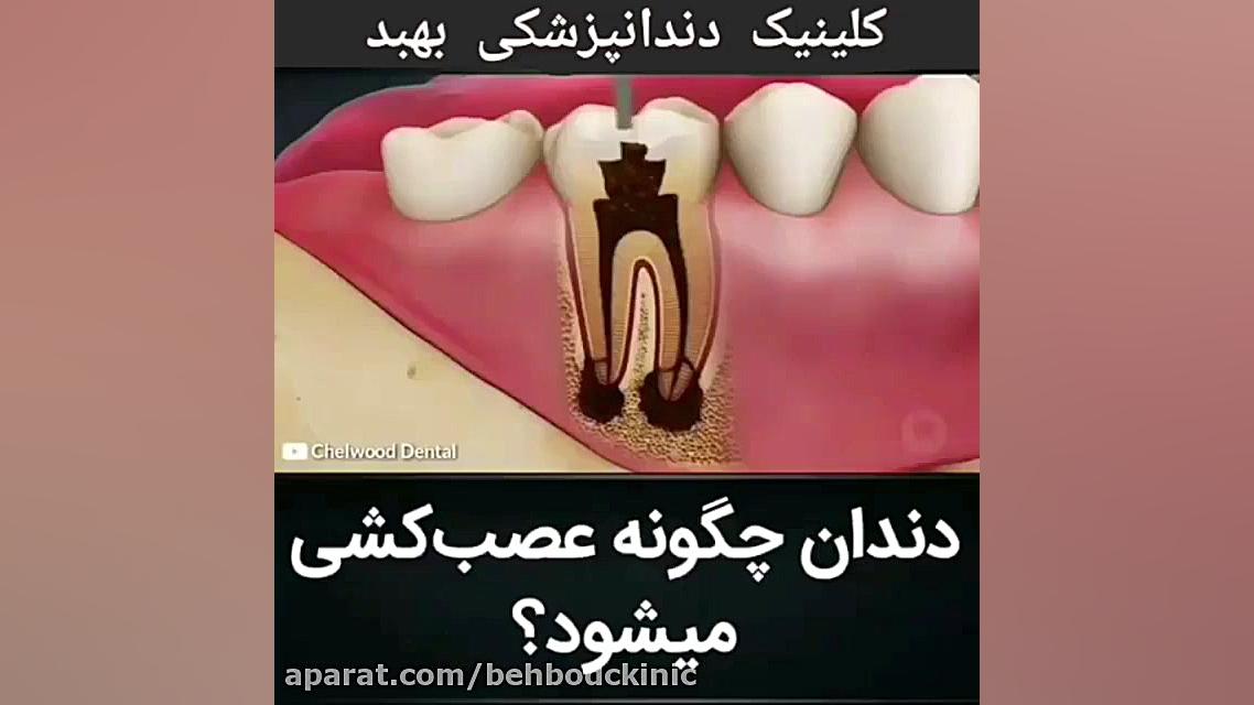 فیلم مراحل عصب کشی دندان Southern Blot