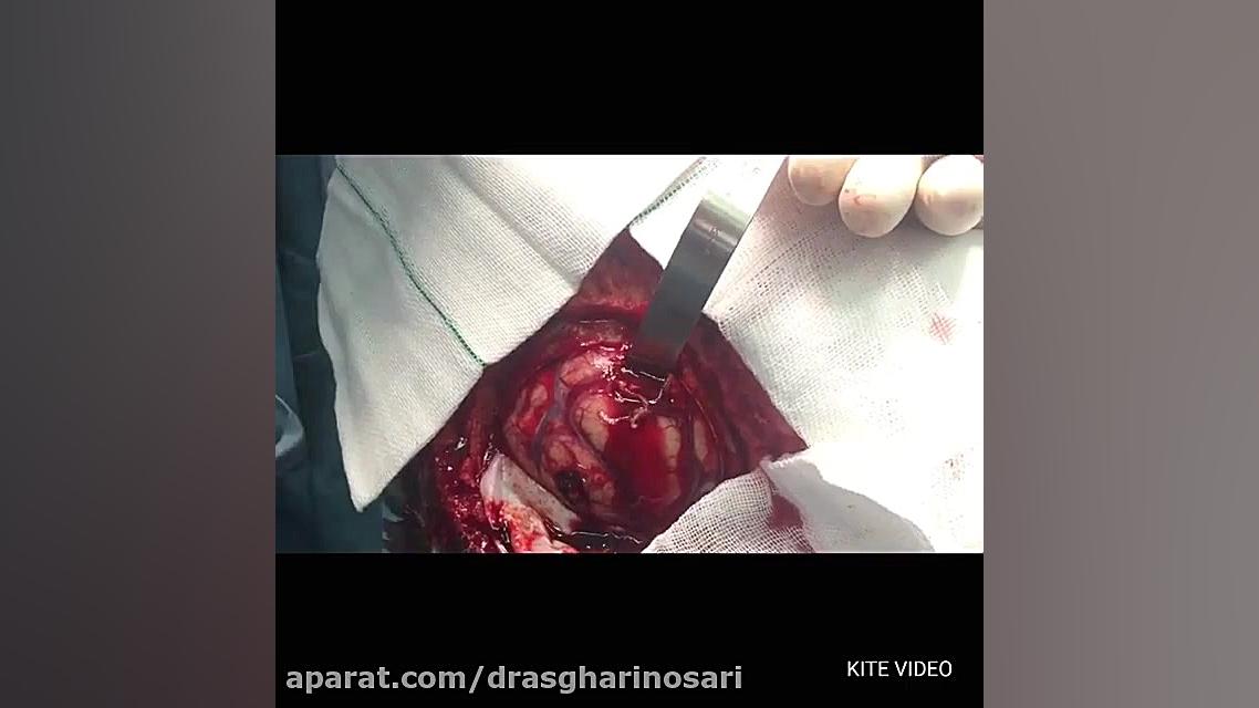 عمل جراحی اورژانس تخلیه خونریزی بسیار وسیع مغزی / دکتر مسعود اصغری نوسری لیپوست