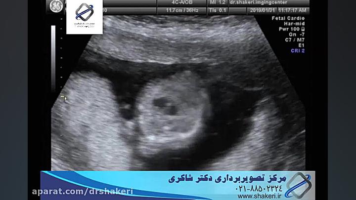 سونوگرافی ساده، 4 بعدی و کالرداپلر / مرکز تصویربرداری دکتر شاکری پالپوتومی