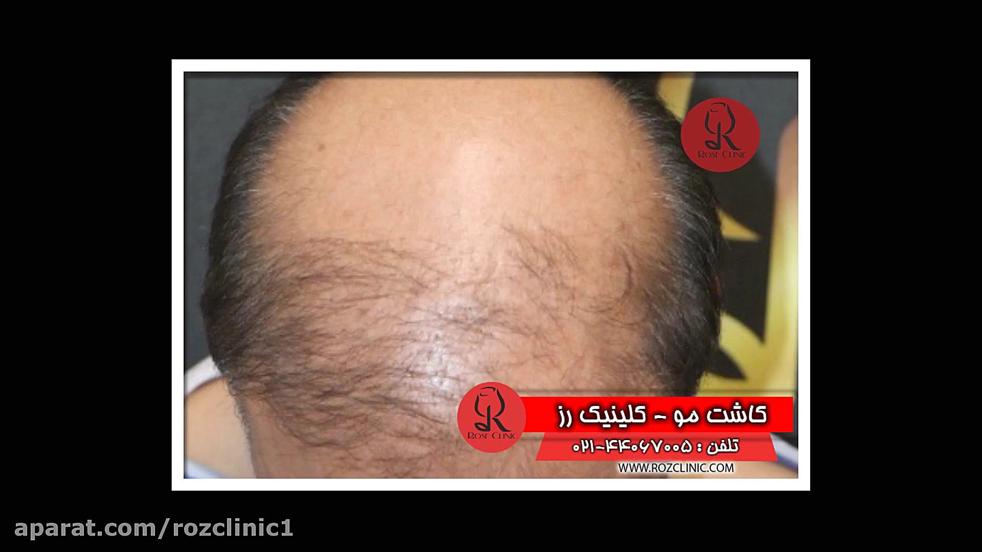کاشت مو | فیلم کاشت مو | کلینیک پوست و مو رز | شماره20 هایفوتراپی
