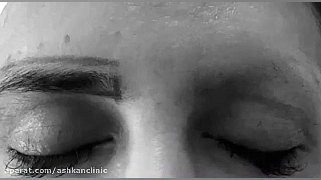 کلینیک زیبایی، لیزر و لاغری اشکان آزمایش ایمونوسورپشن