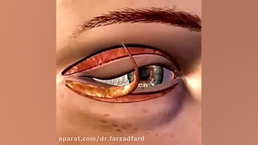 انیمیشن جراحی پلک دکتر اسماعیل فرزاد فرد - فوق تخصص پلاستیک