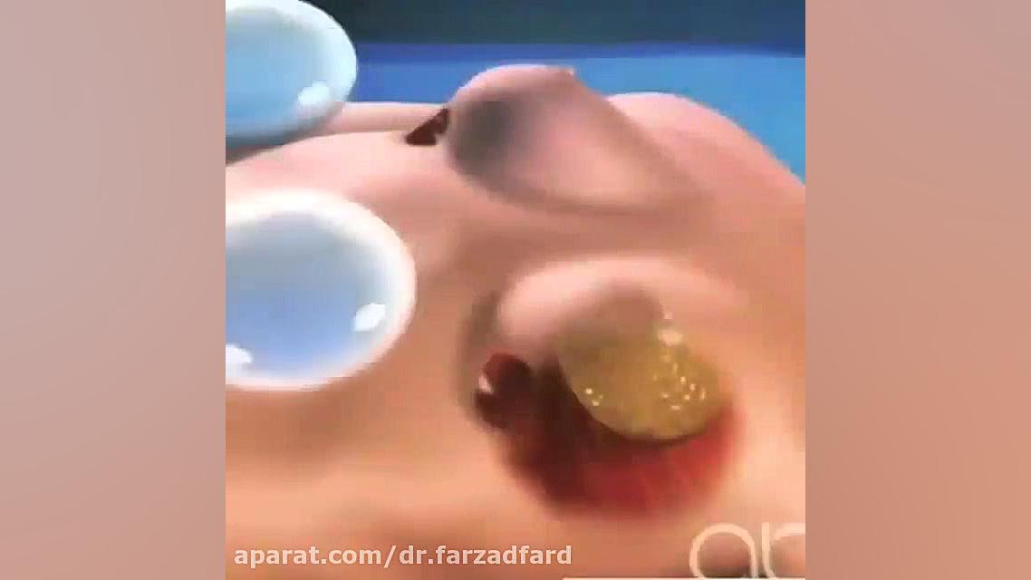 پروتز سینه دکتر اسماعیل فرزاد فرد - فوق تخصص پلاستیک