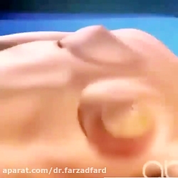پروتز سینه پروتز سینه
