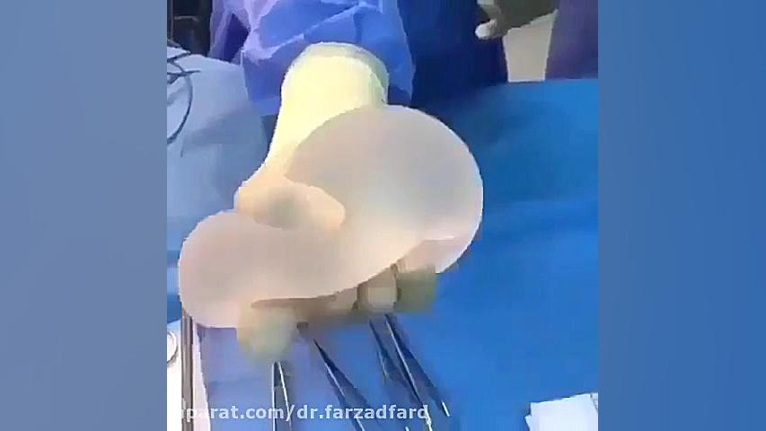 انعطاف پذیری پروتز سینه دکتر اسماعیل فرزاد فرد - فوق تخصص پلاستیک