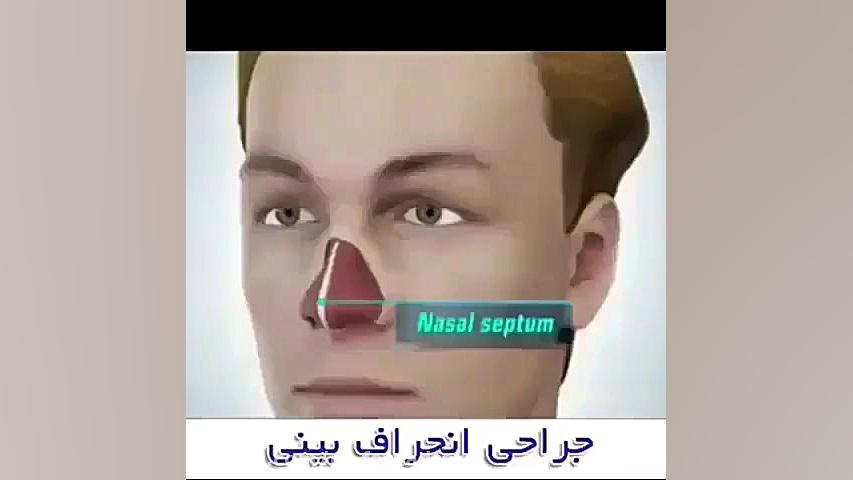 انحراف بینی دکتر اسماعیل فرزاد فرد - فوق تخصص پلاستیک