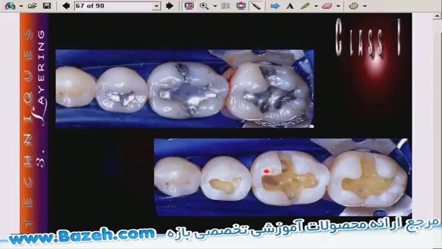 ترمیم مستقیم دندان های خلفی - Posterior Restorations زوترلینیب