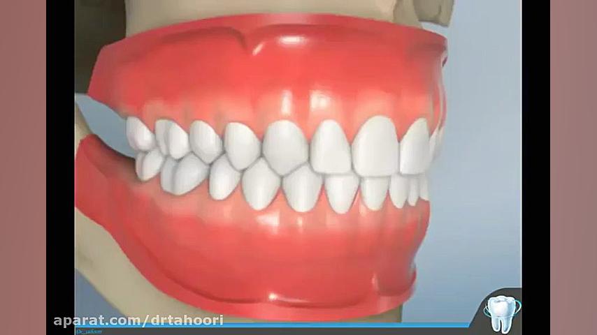 آموزش مراحل ترمیم دندان با کامپوزیت-دکترزهراطهوریwww.pardisdental.ir هالوسیناتوری بویایی