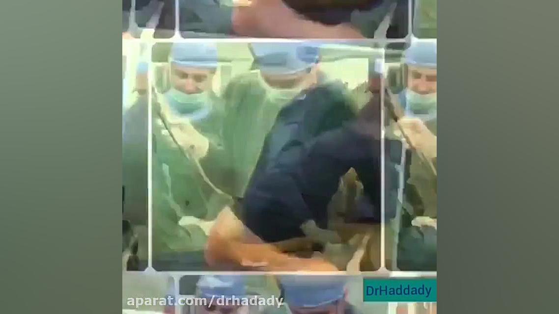 لیپو با دستگاه پال میکروای مورگان فریمن