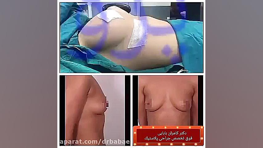 پروتز سینه Ribo-Seq