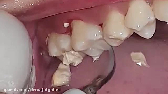 جرمگیری دندان-دکترمجیدقیاسی-جراح ودندانپزشک مشهد دکترمجیدقیاسی