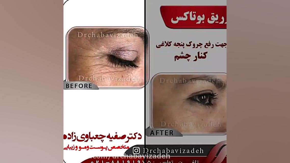 تزریق بوتاکس جهت رفع خطوط پنجه کلاغی کنار چشم | دکتر چعباوی زاده دکتر صفیه چعباوی زاده