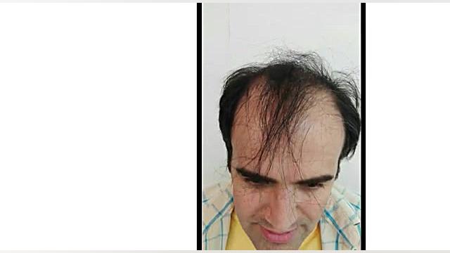 شش ماه بعد از کاشت مو | دکتر صفیه چعباوی زاده دکتر صفیه چعباوی زاده