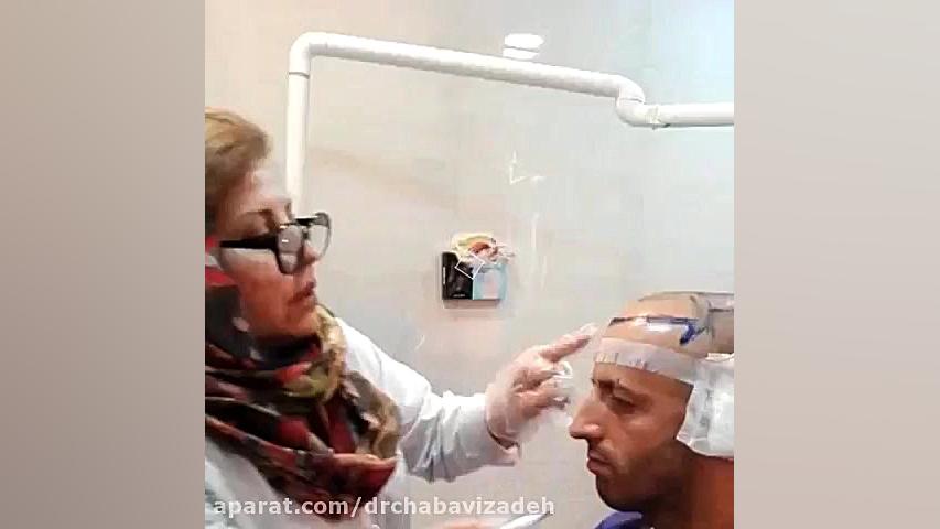 مراحل انجام کاشت مو | دکتر صفیه چعباوی زاده دکتر صفیه چعباوی زاده