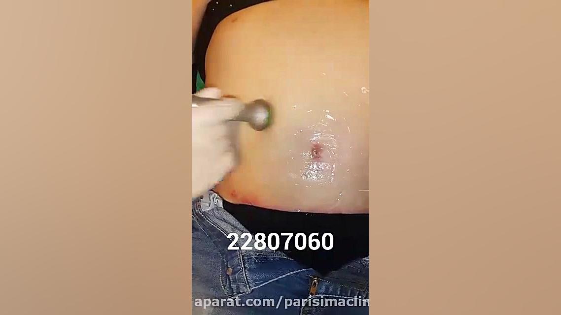 LDM - کلینیک زیبایی پری سیما - 22807060 لیپوساکشن
