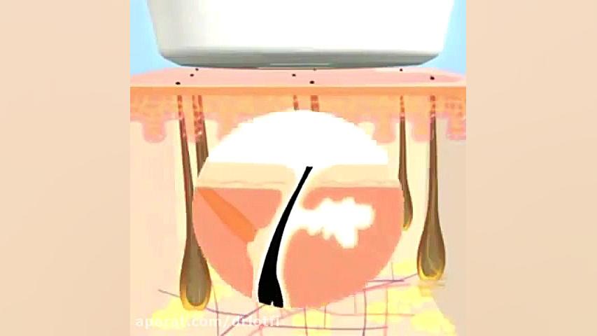 لیزر موهای زائد دکتر سار ا لطفی