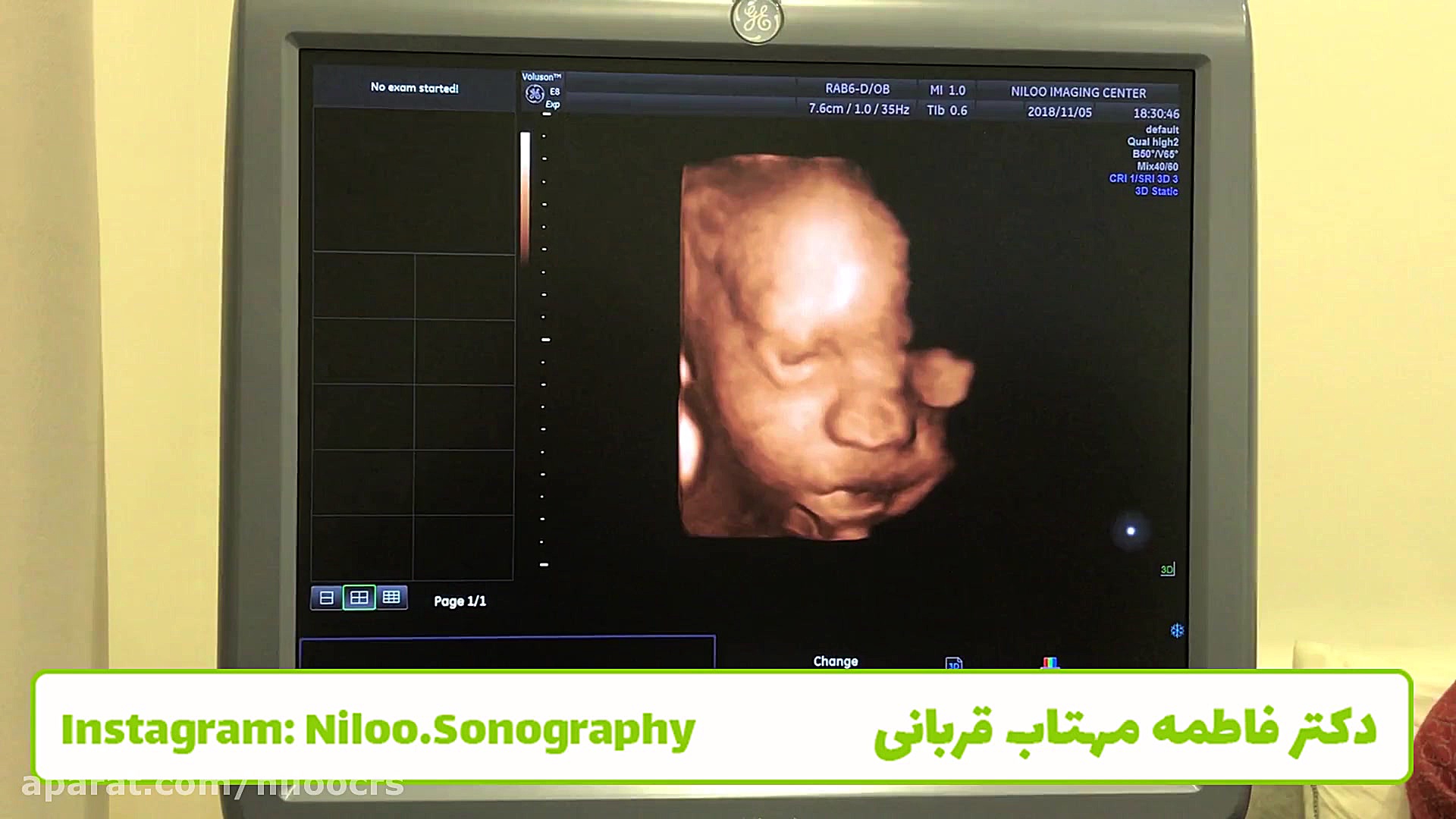 فیبروم در بارداری سونوگرافی نیلو دکتر فاطمه مهتاب قربانی