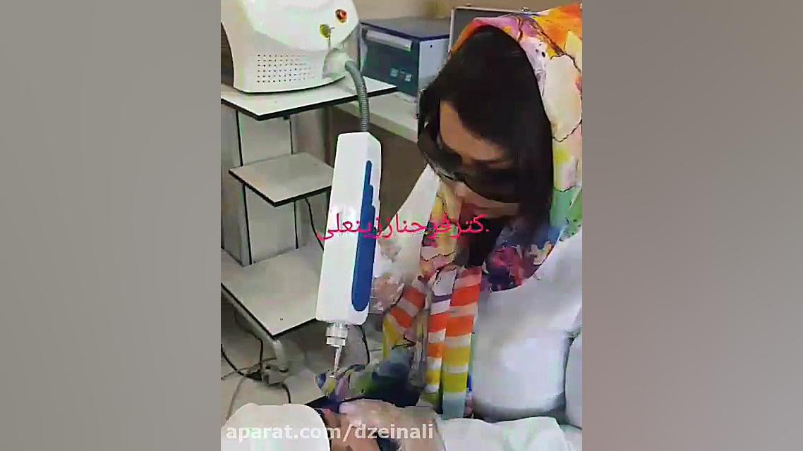 پاک کردن تاتوی ابرو با لیزر کیوسویچ دکتر فرحناز زینعلی - متخصص پوست، مو، زیبایی زنجان