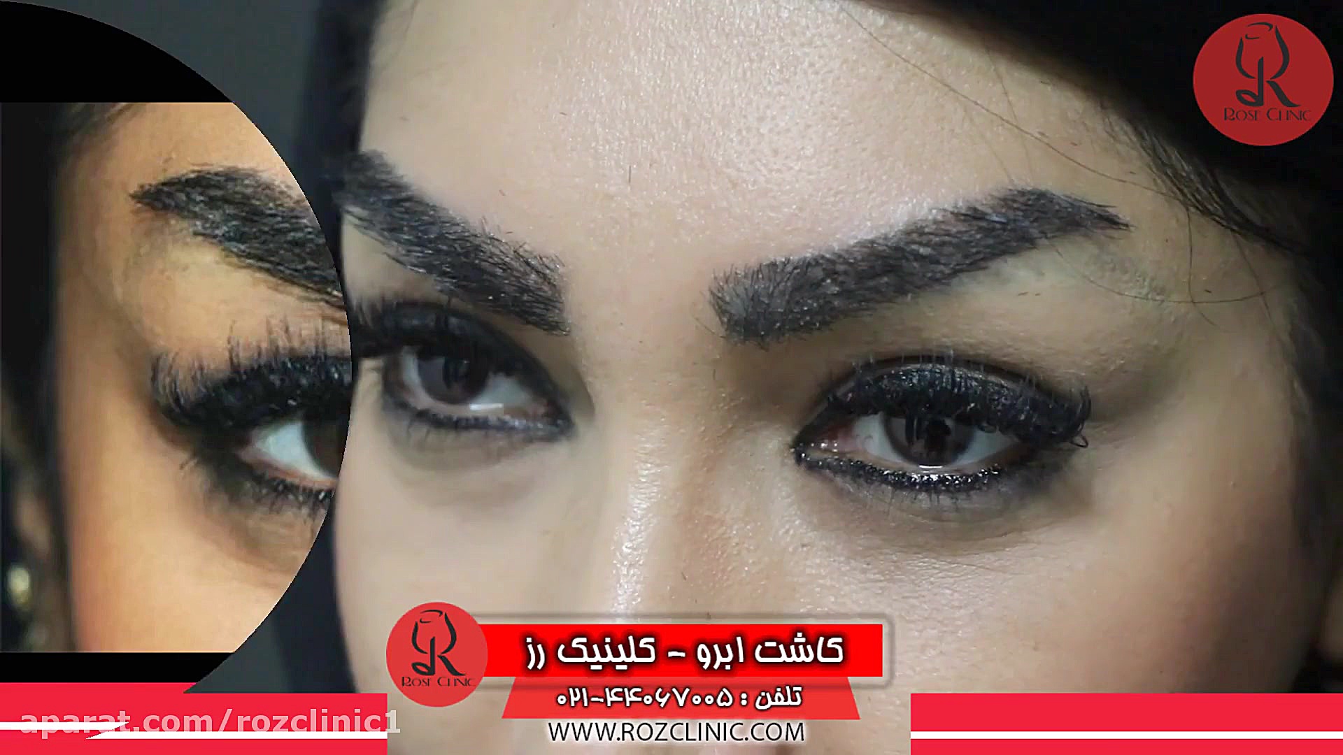 کاشت ابرو | فیلم کاشت ابرو | کلینیک پوست و مو رز | شماره50 زاویه سازی صورت
