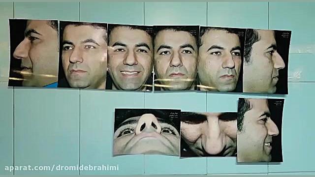 جراحی بینی گوشتی توسط دکتر امید ابراهیمی بهترین جراح بینی دکتر امید ابراهیمی