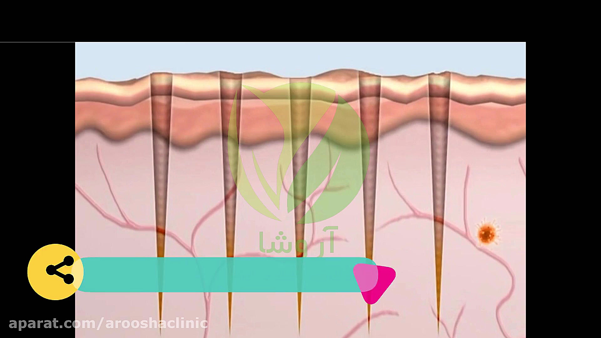 جوانسازی پوست با استفاده از لیزر اسکارلت کلینیک زیبائی دکتر مهرشاد رابط