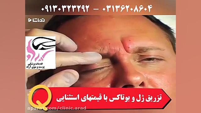 نحوه تزریق بوتاکس پیشانی و اثر آن کلینیک زیبایی