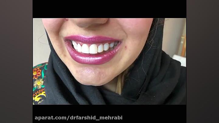 فیلم کامپوزیت دندان | کامپوزیت ونیر دندان والسارتان