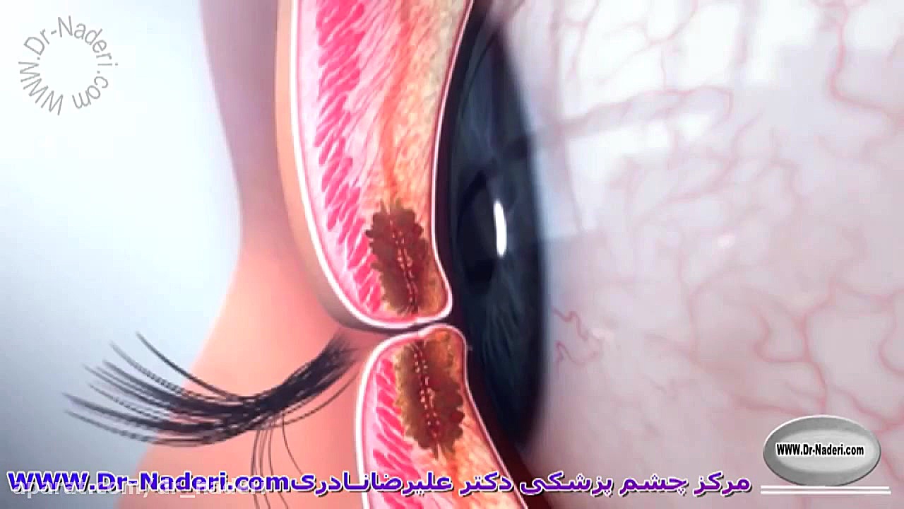 ترکیبات اشک طبیعی چشم - مرکز چشم پزشکی دکتر علیرضا نادری مرکز چشم پزشکی دکتر علیرضا نادری www.dr-naderi.com