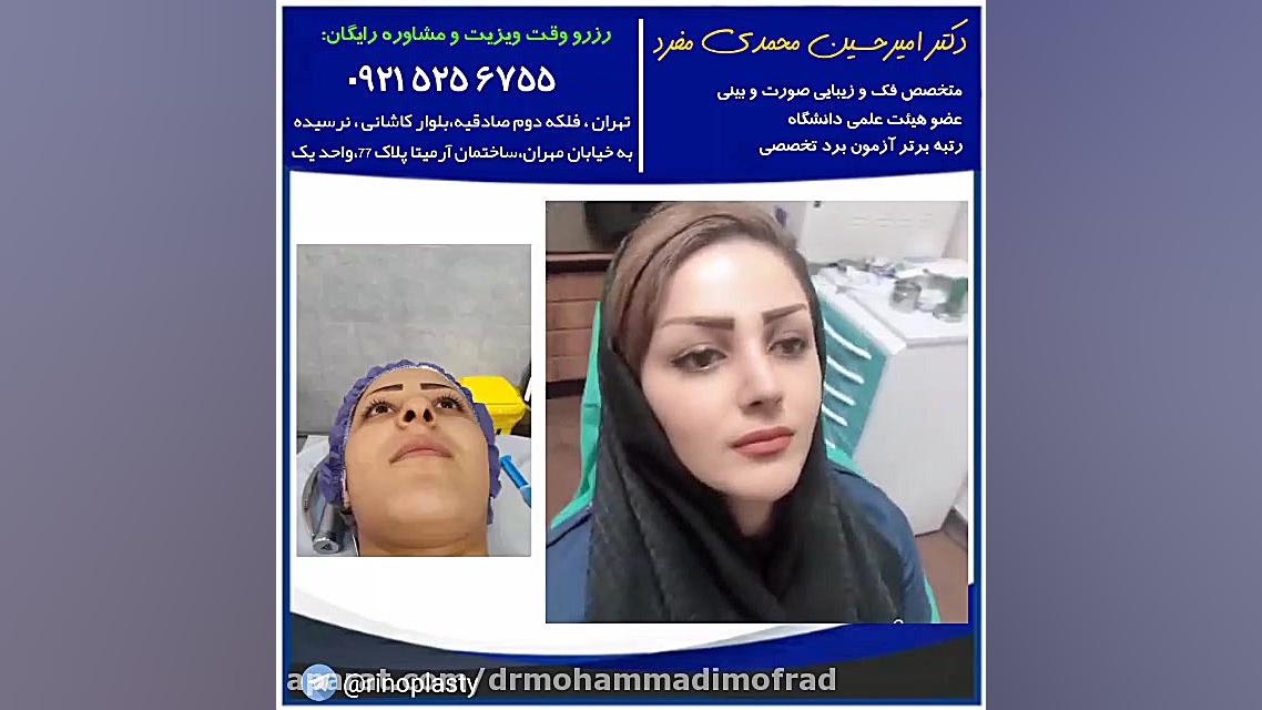 عمل زیبایی بینی (دکتر امیر حسین محمدی مفرد) دکتر امیر حسین محمدی مفرد