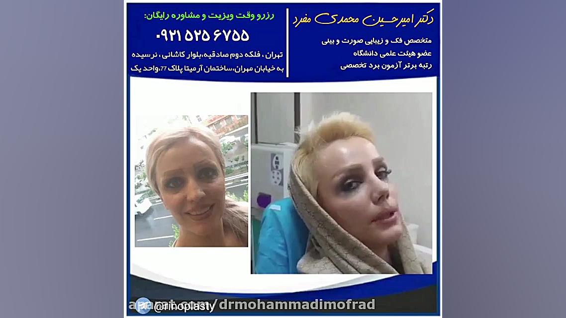 عمل زیبایی بینی (دکتر امیر حسین محمدی مفرد)09215256755 دکتر امیر حسین محمدی مفرد