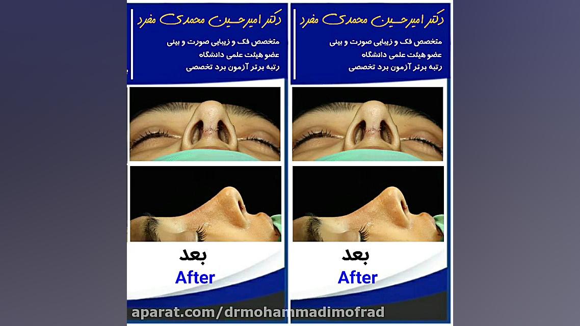 عمل زیبایی بینی (دکتر امیر حسین محمدی مفرد) دکتر امیر حسین محمدی مفرد