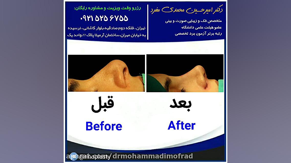 عمل زیبایی بینی (دکتر امیر حسین محمدی مفرد) دکتر امیر حسین محمدی مفرد