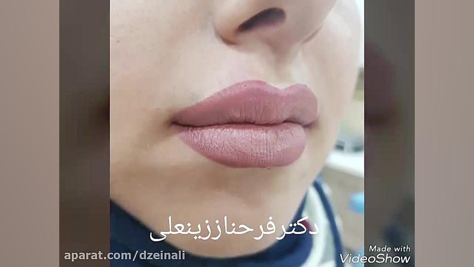 تزریق هشت دهم سی سی ژل با کیفیت بالا دکتر فرحناز زینعلی - متخصص پوست، مو، زیبایی زنجان