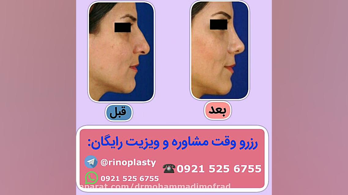 عمل زیبایی بینی (دکتر امیر حسین محمدی مفرد)09215256755 دکتر امیر حسین محمدی مفرد