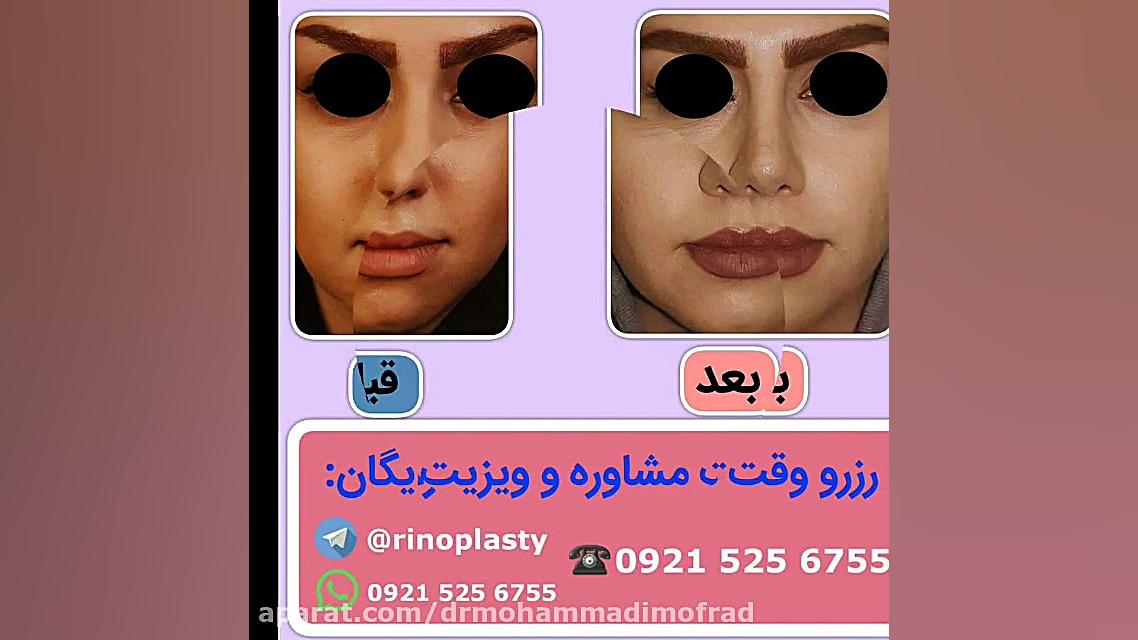 عمل زیبایی بینی (دکتر امیر حسین محمدی مفرد)09215256755 دکتر امیر حسین محمدی مفرد