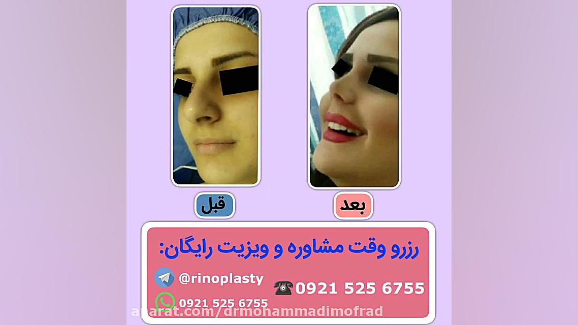 عمل زیبایی بینی (دکتر امیر حسین محمدی مفرد)09215256755 دکتر امیر حسین محمدی مفرد