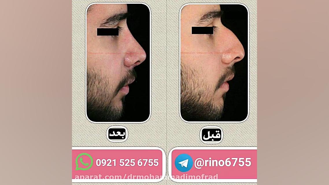 عمل زیبایی بینی (دکتر امیر حسین محمدی مفرد)09215256755 دکتر امیر حسین محمدی مفرد