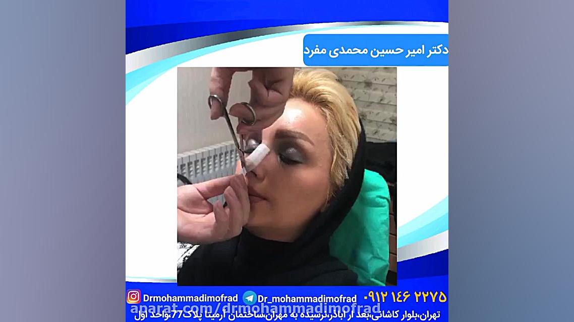 آموزش چسب زدن بینی (دکتر امیر حسین محمدی مفرد)09215256755 دکتر امیر حسین محمدی مفرد