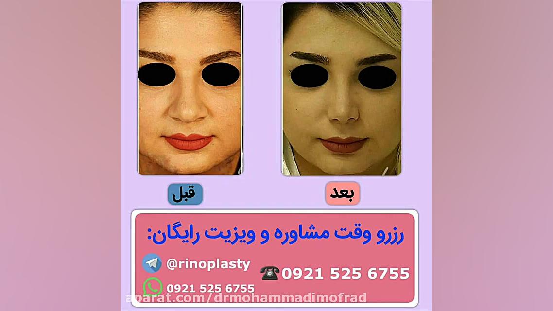 عمل زیبایی بینی (دکتر امیر حسین محمدی مفرد)09215256755 دکتر امیر حسین محمدی مفرد