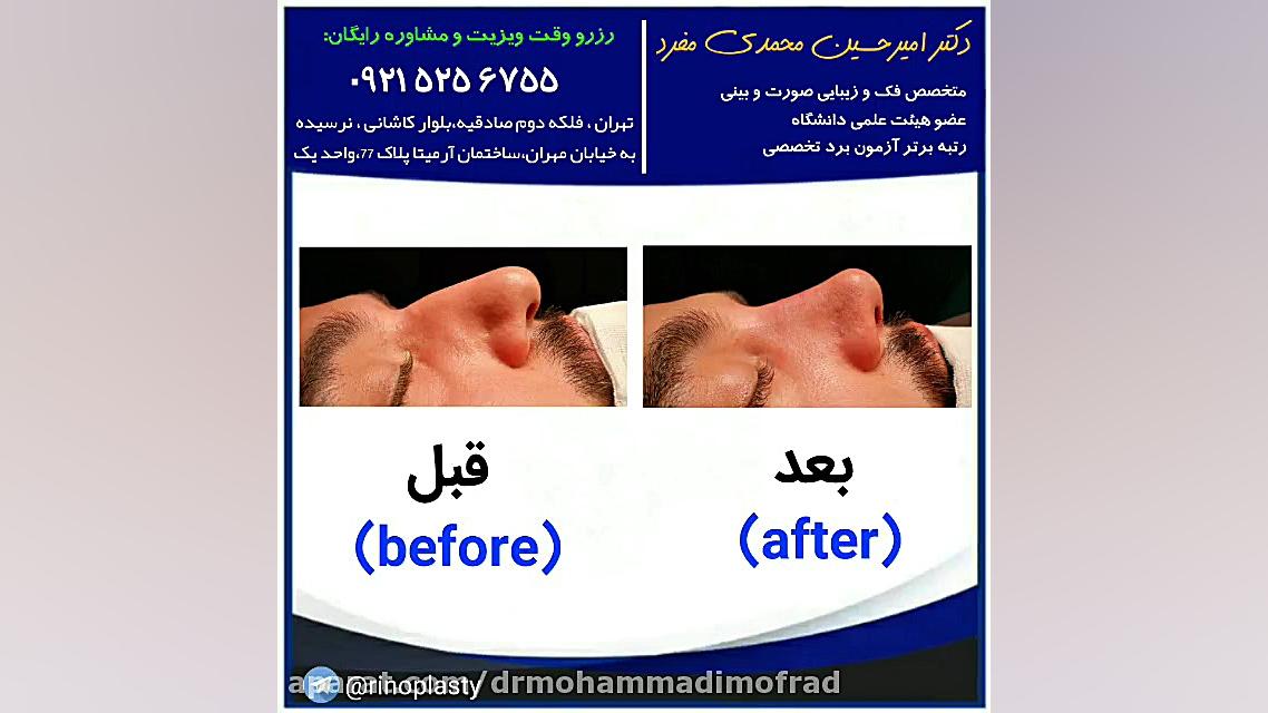 عمل زیبایی بینی (دکتر امیر حسین محمدی مفرد)09215256755 دکتر امیر حسین محمدی مفرد