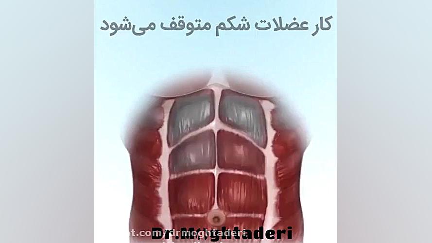 چطور غوز نکنیم ؟ دکتر علیرضا مقتدری | متخصص طب فیزیکی