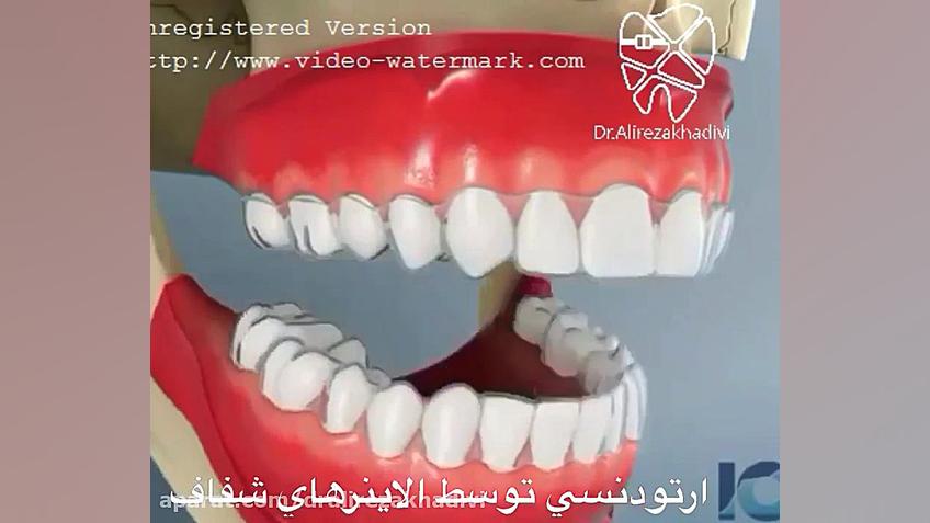 ارتودنسی توسط الاینرهای شفاف دکتر علیرضا خدیوی