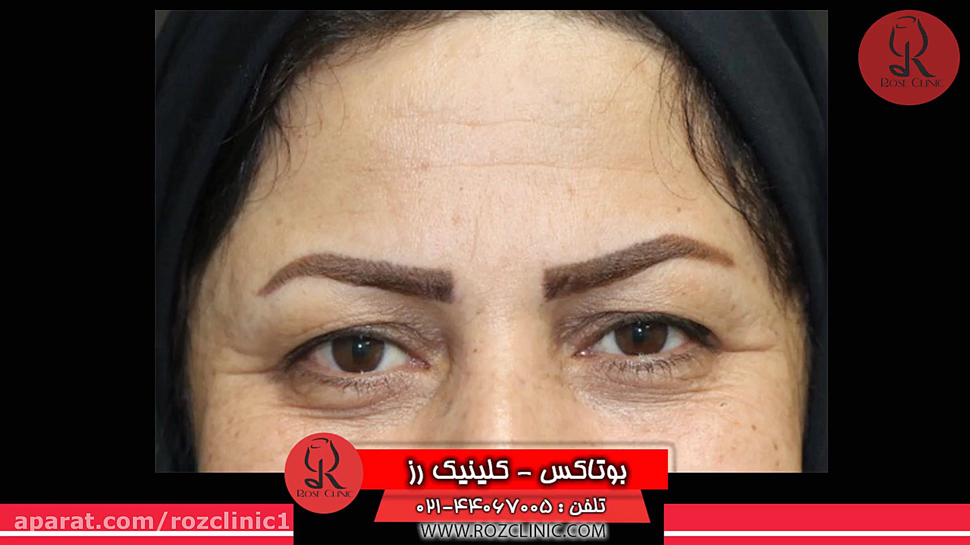 تزریق بوتاکس | فیلم تزریق بوتاکس | کلینیک پوست و مو رز | 15 اکستنشن تاج دندان