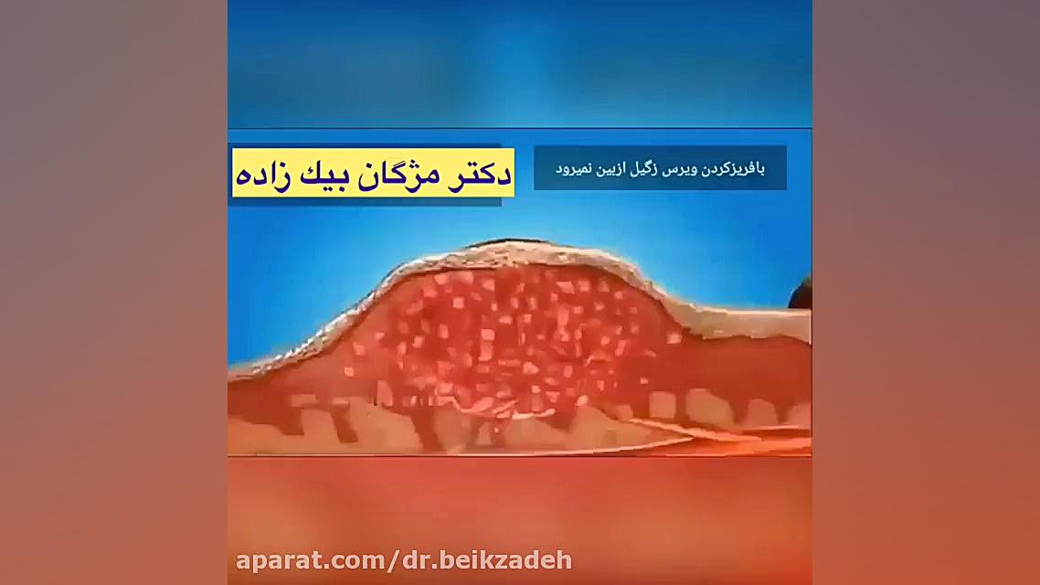 درمان زگیل تناسلی چگونه است؟ دکتر مژگان بیک زاده ( جراح و متخصص زنان و زایمان)
