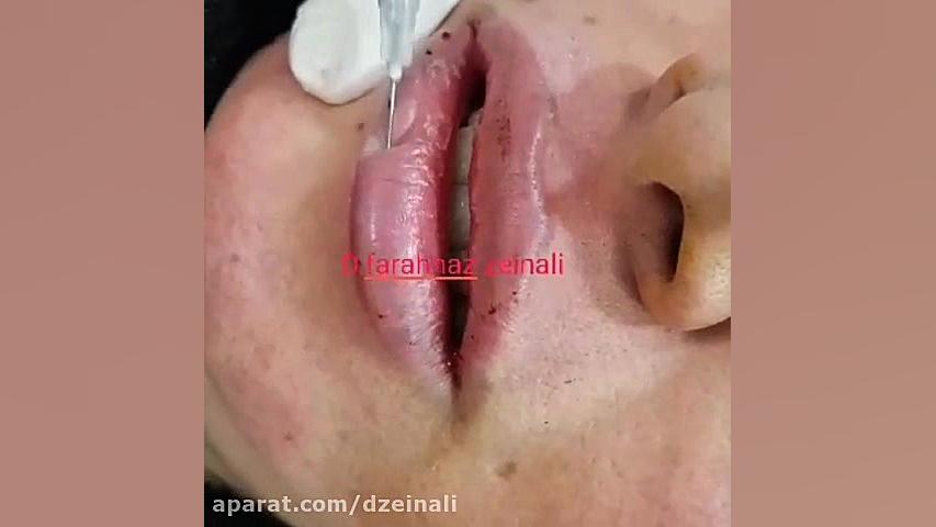 تزریق ژل لب دکتر فرحناز زینعلی - متخصص پوست، مو، زیبایی زنجان
