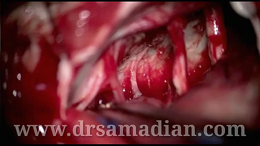 مننژیوم بزرگ قاعده جمجمه لیزر فرکشنال
