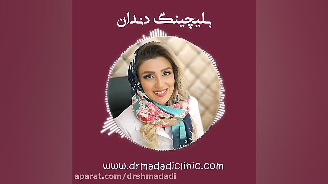 بلیچینگ دندان کربوکسی تراپی